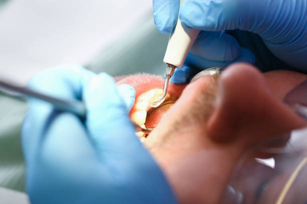 Best Emergency Treatment for Dental Infections or Abscesses in Culpeper, VA